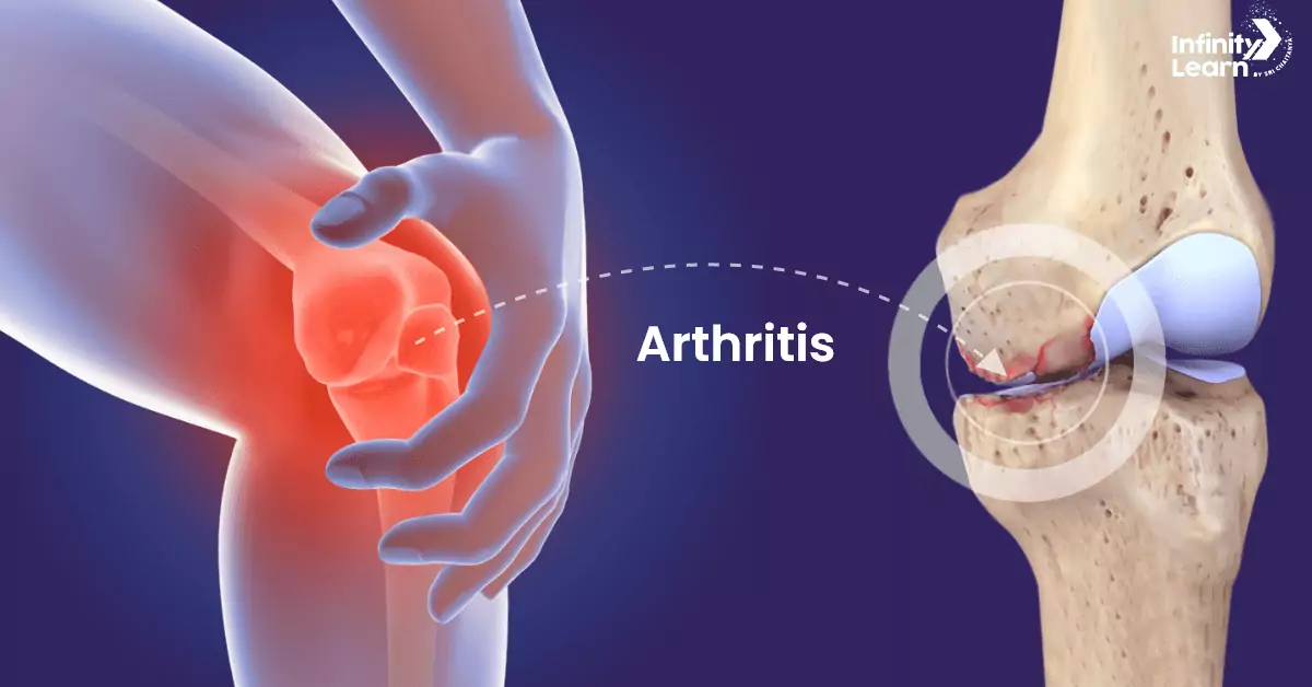 98% of people with arthritis don’t even know about a simple an…